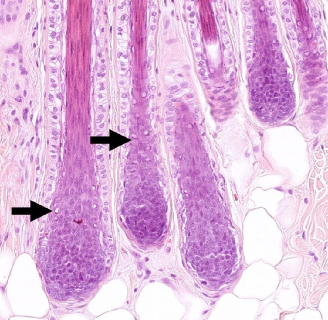 Exemplo de um folículo em “chama” característico da Alopecia X - imagem histopatológica