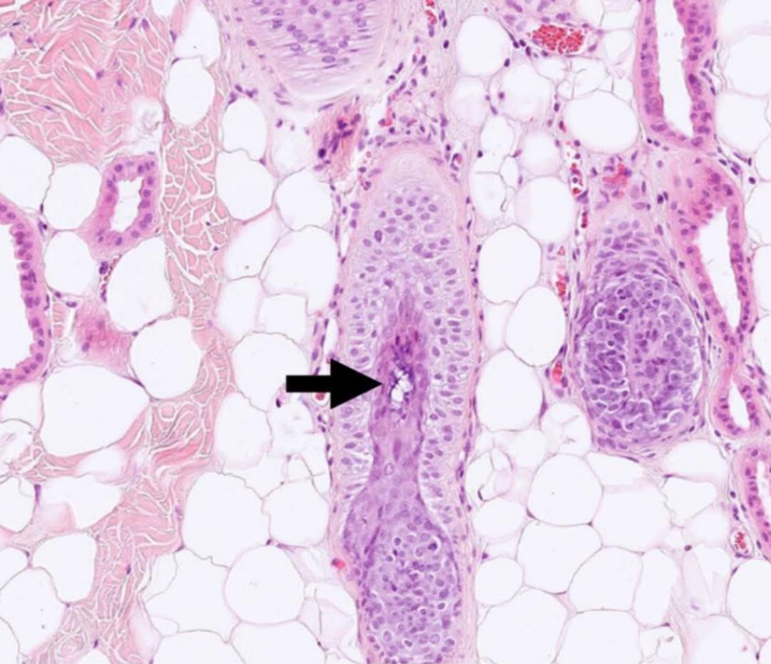 Exemplo de um folículo em “chama” característico da Alopecia X - imagem histopatológica